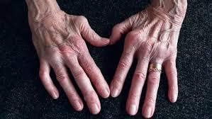 Rheumatoid Arthritis 