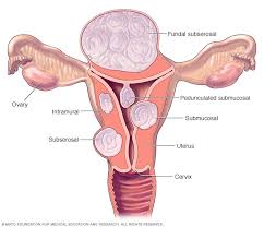 fibroids