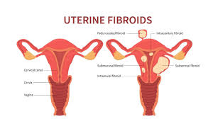 Fibroids