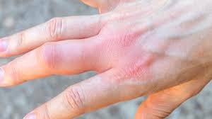 Inflammation